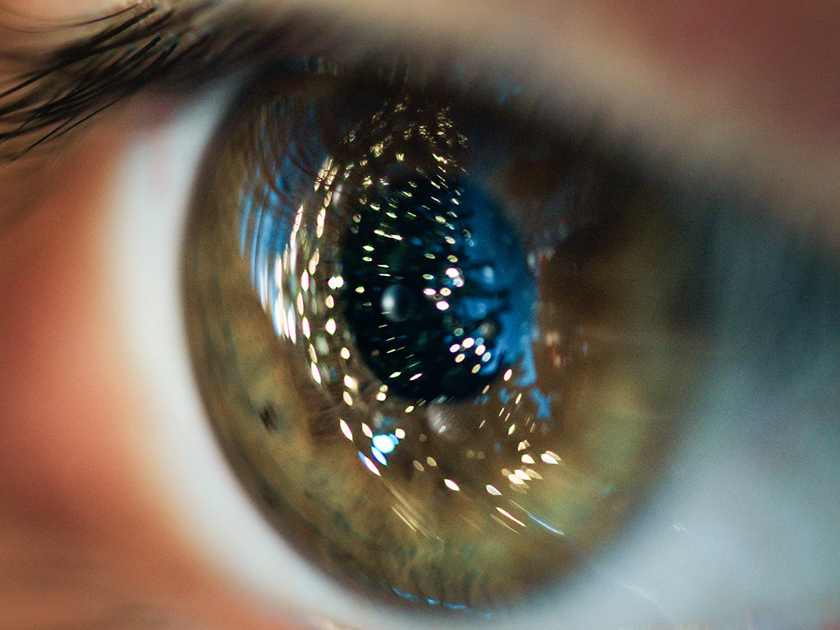 Ранната диагностика на глаукомата е основен фактор за запазване на зрителната функция