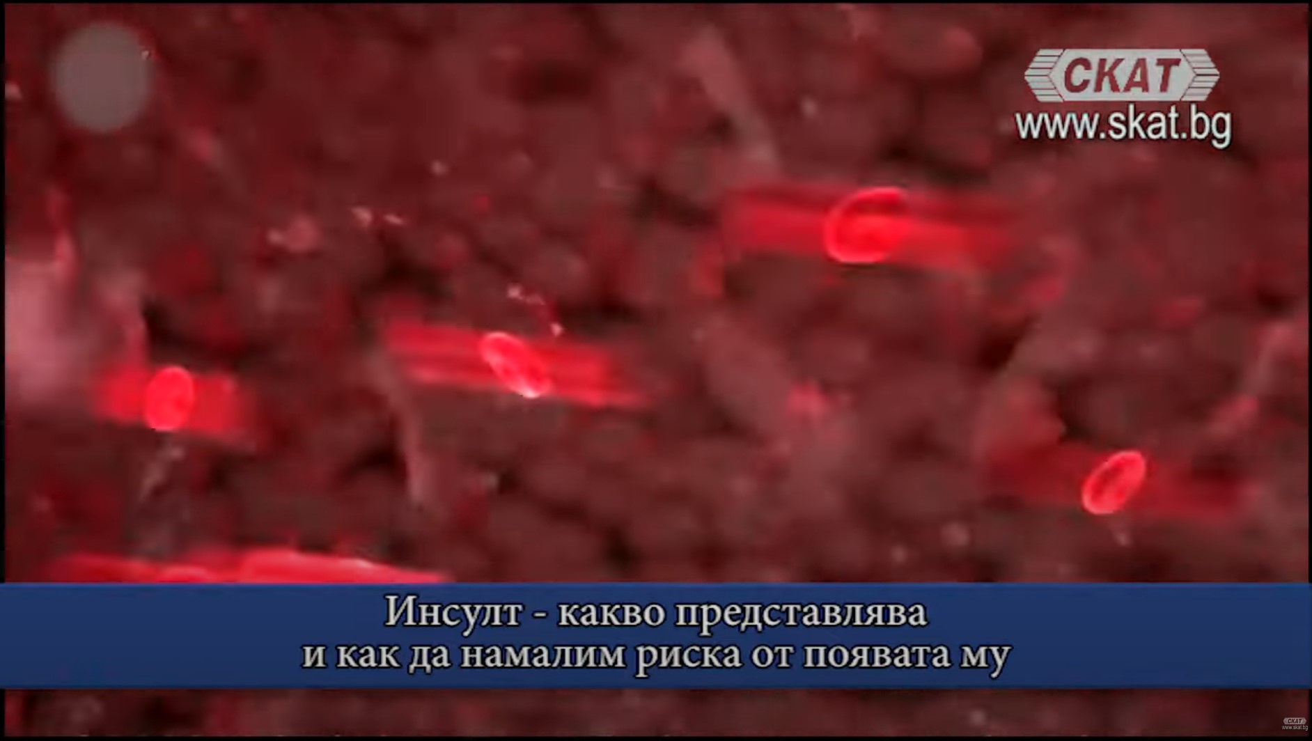 Д-р Анъл Хюсменов, невролог в МЦ "Лозенец" в студиото на телевизия СКАТ